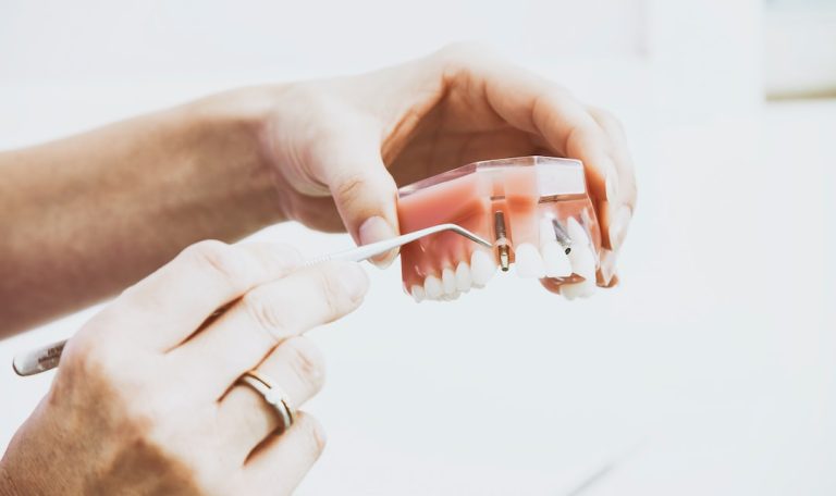 how long do dental implants last