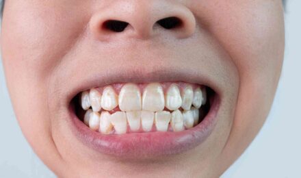 teeth showing bad dental habits